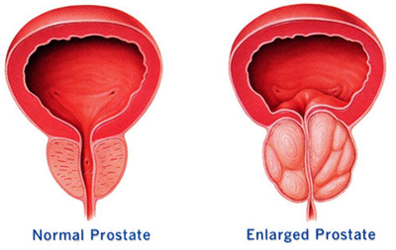 Prostate Problem Treatment